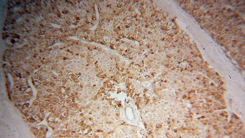 Immunohistochemical of paraffin-embedded human liver cancer using Catalog No:109073(CCPG1 antibody) at dilution of 1:50 (under 10x lens)