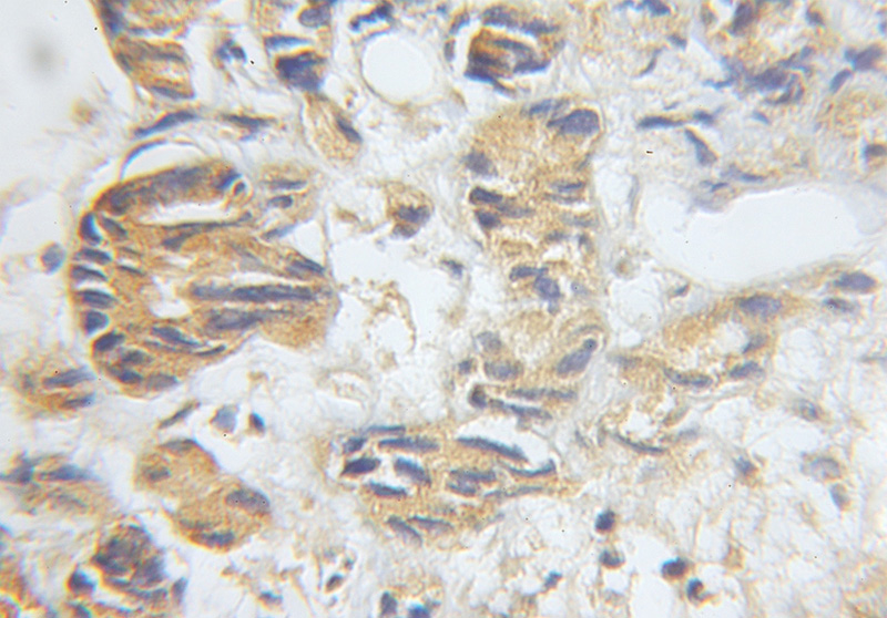 Immunohistochemical of paraffin-embedded human prostate cancer using Catalog No:109749(DCI antibody) at dilution of 1:50 (under 10x lens)
