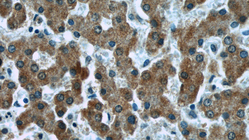 Immunohistochemistry of paraffin-embedded human liver tissue slide using Catalog No:107169(CFB Antibody) at dilution of 1:50 (under 40x lens)