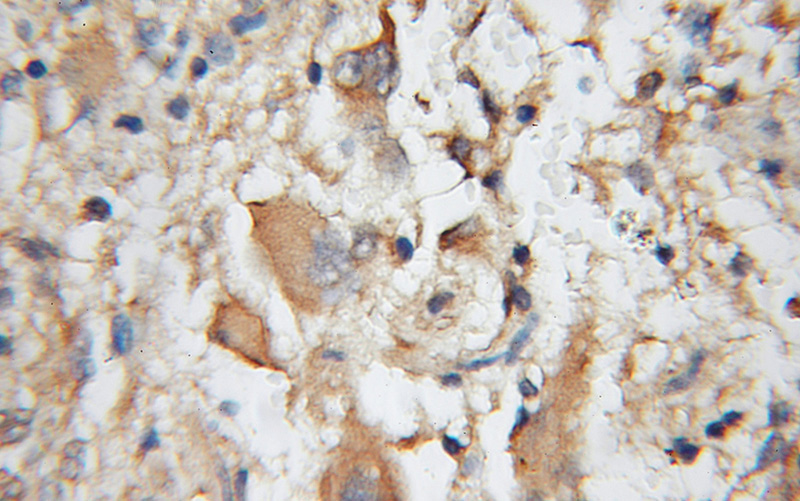 Immunohistochemical of paraffin-embedded human gliomas using Catalog No:108752(CA8 antibody) at dilution of 1:100 (under 10x lens)