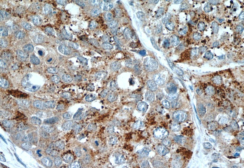 Immunohistochemistry of paraffin-embedded human cervical cancer tissue slide using Catalog No:111377(HDAC4 Antibody) at dilution of 1:50 (under 40x lens)