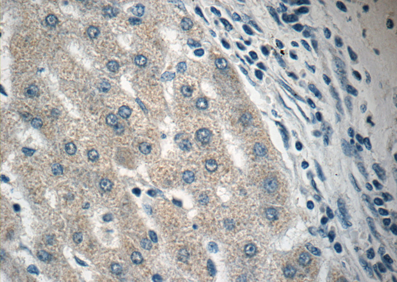 Immunohistochemistry of paraffin-embedded human liver cancer tissue slide using Catalog No:114892(RPL36AL Antibody) at dilution of 1:50 (under 40x lens)