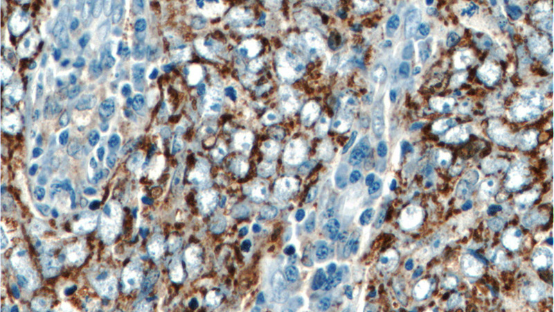 Immunohistochemistry of paraffin-embedded human breast cancer tissue slide using Catalog No:115493(SOD2 Antibody) at dilution of 1:50 (under 40x lens)