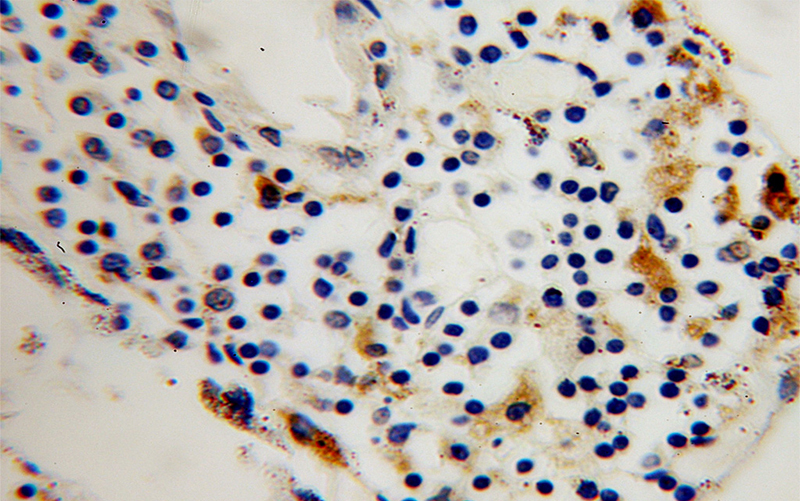 Immunohistochemical of paraffin-embedded human colon cancer using Catalog No:116209(TPP1 antibody) at dilution of 1:50 (under 40x lens)