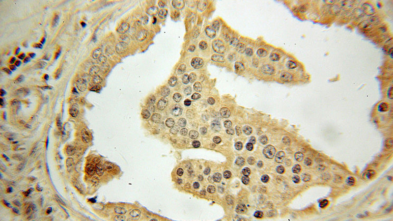 Immunohistochemical of paraffin-embedded human prostate cancer using Catalog No:108161(ACTR2 antibody) at dilution of 1:50 (under 10x lens)