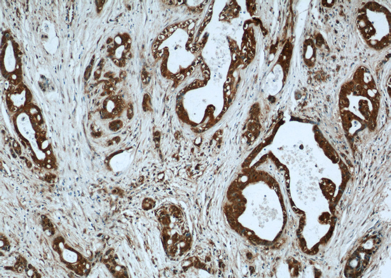 Immunohistochemical of paraffin-embedded human liver cancer using Catalog No:112227(LIMD2 antibody) at dilution of 1:50 (under 10x lens)