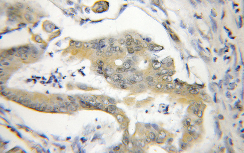 Immunohistochemical of paraffin-embedded human colon cancer using Catalog No:113010(NA14 antibody) at dilution of 1:50 (under 10x lens)