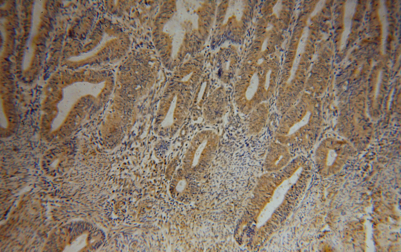 Immunohistochemical of paraffin-embedded human endometrial cancer using Catalog No:114613(RBM41 antibody) at dilution of 1:100 (under 10x lens)