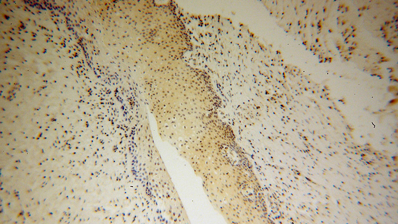Immunohistochemical of paraffin-embedded human cervical cancer using Catalog No:111244(GTPBP4 antibody) at dilution of 1:100 (under 10x lens)