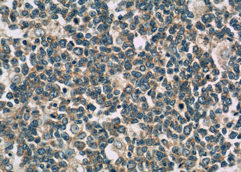 Immunohistochemistry of paraffin-embedded human tonsillitis tissue slide using Catalog No:107396(IL28A Antibody) at dilution of 1:50 (under 40x lens)