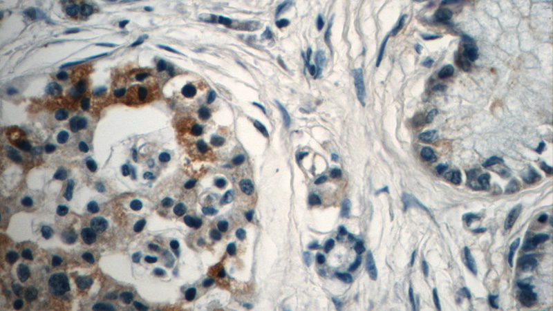 Immunohistochemistry of paraffin-embedded human pancreas cancer tissue slide using Catalog No:110388(LIMA1 Antibody) at dilution of 1:50 (under 40x lens)