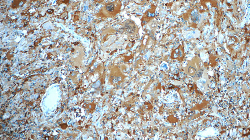 Immunohistochemistry of paraffin-embedded human gliomas tissue slide using Catalog No:113372(NUMBLIKE Antibody) at dilution of 1:50 (under 10x lens)
