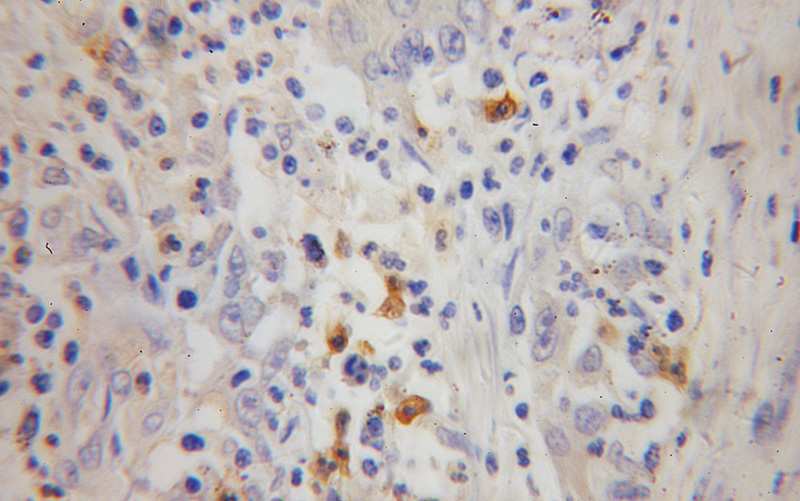 Immunohistochemical of paraffin-embedded human colon cancer using Catalog No:110645(FGL2 antibody) at dilution of 1:50 (under 40x lens)