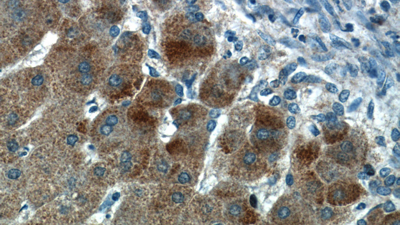 Immunohistochemical of paraffin-embedded human hepatocirrhosis using Catalog No:111275(HBXIP antibody) at dilution of 1:50 (under 40x lens)