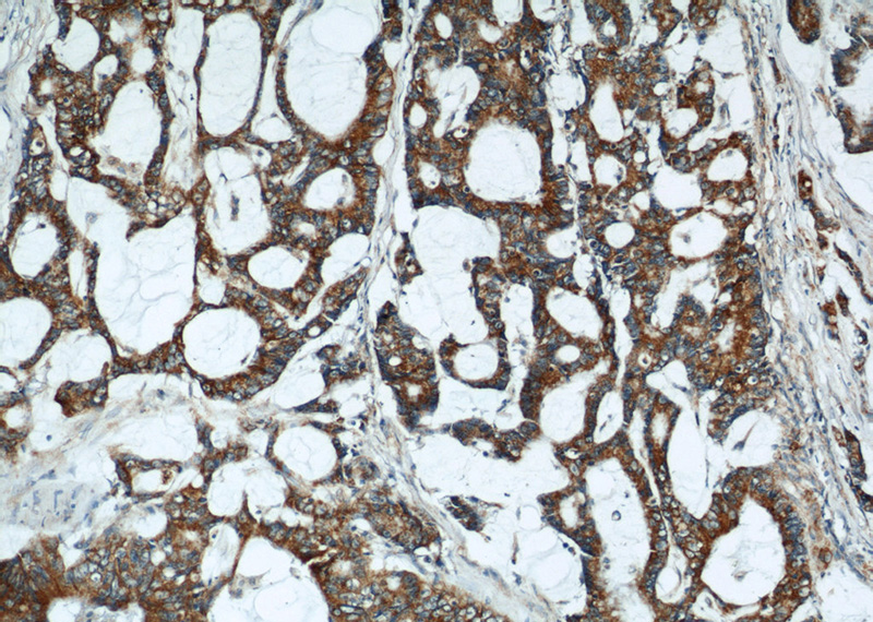 Immunohistochemical of paraffin-embedded human colon cancer using Catalog No:109785(CYCS antibody) at dilution of 1:50 (under 10x lens)