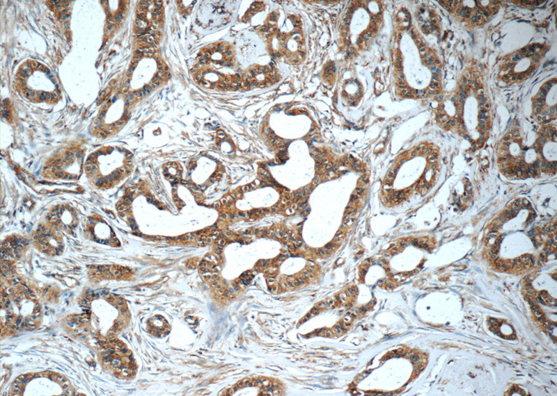 Immunohistochemistry of paraffin-embedded human breast cancer tissue slide using Catalog No:107376(LGALS3BP Antibody) at dilution of 1:50 (under 10x lens)