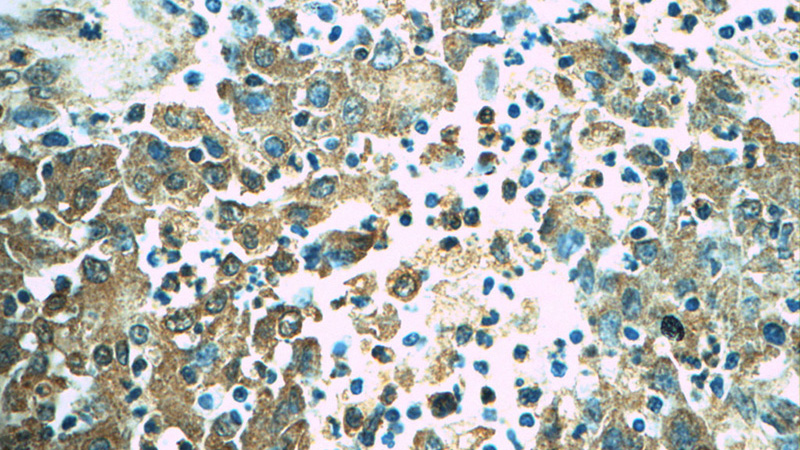 Immunohistochemistry of paraffin-embedded human colon cancer tissue slide using Catalog No:113419(Orail-L2 Antibody) at dilution of 1:50 (under 40x lens)