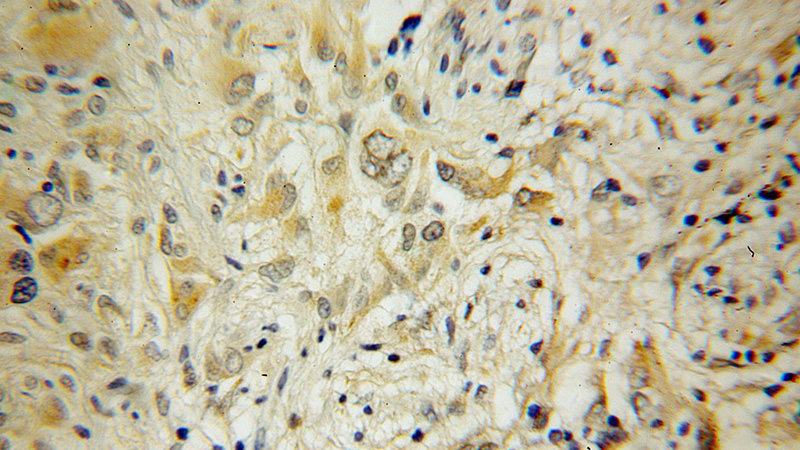 Immunohistochemical of paraffin-embedded human gliomas using Catalog No:114457(RAB6B antibody) at dilution of 1:50 (under 40x lens)