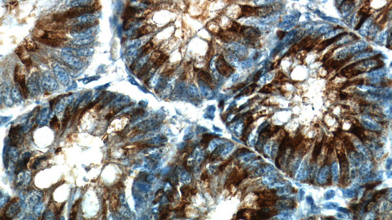 Immunohistochemistry of paraffin-embedded human colon slide using Catalog No:116355(TFF3 Antibody) at dilution of 1:50