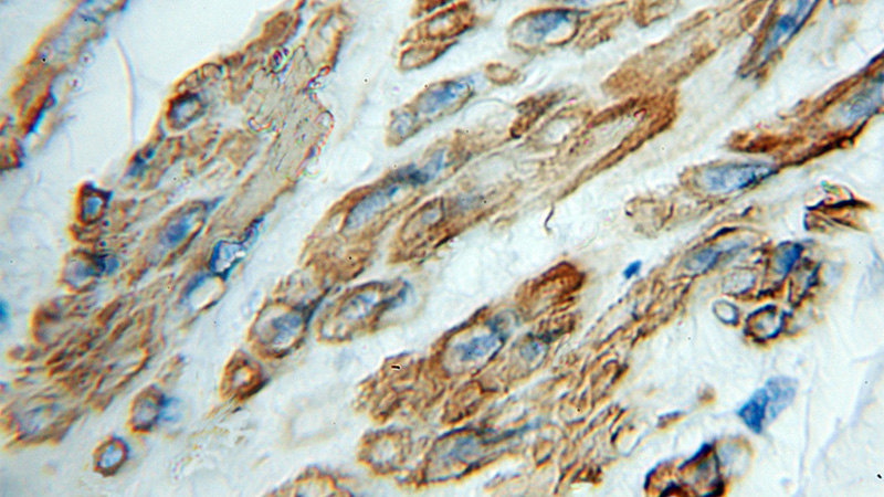 Immunohistochemical of paraffin-embedded human colon cancer using Catalog No:111918(RP1-21O18.1 antibody) at dilution of 1:100 (under 10x lens)