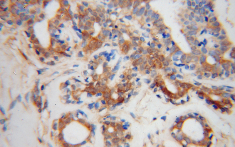 Immunohistochemical of paraffin-embedded human breast cancer using Catalog No:114900(RPL7A antibody) at dilution of 1:100 (under 40x lens)