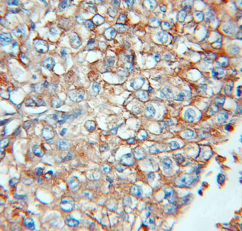 Immunohistochemical of paraffin-embedded human lung cancer using Catalog No:111624(IFITM3 antibody) at dilution of 1:100 (under 10x lens)