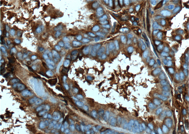 Immunohistochemistry of paraffin-embedded human ovary tumor tissue slide using Catalog No:107150(CP Antibody) at dilution of 1:200 (under 40x lens). heat mediated antigen retrieved with Tris-EDTA buffer(pH9).