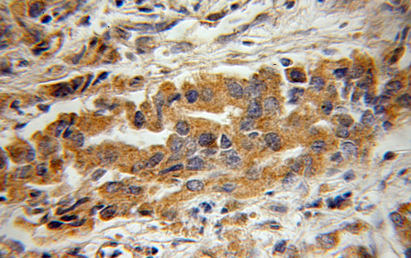 Immunohistochemical of paraffin-embedded human prostate cancer using Catalog No:117148(BIN3 antibody) at dilution of 1:50 (under 10x lens)