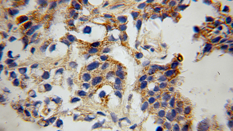 Immunohistochemical of paraffin-embedded human gliomas using Catalog No:111206(GRID1 antibody) at dilution of 1:100 (under 10x lens)