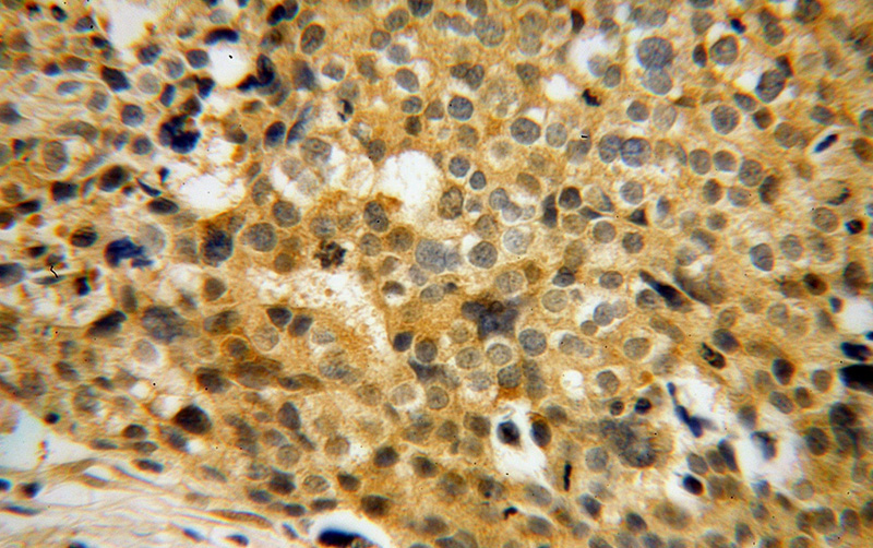 Immunohistochemical of paraffin-embedded human ovary tumor using Catalog No:110651(FHL3 antibody) at dilution of 1:50 (under 40x lens)