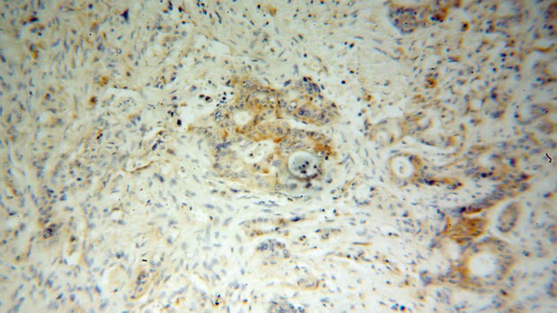 Immunohistochemical of paraffin-embedded human colon cancer using Catalog No:111920(KBTBD2 antibody) at dilution of 1:50 (under 10x lens)