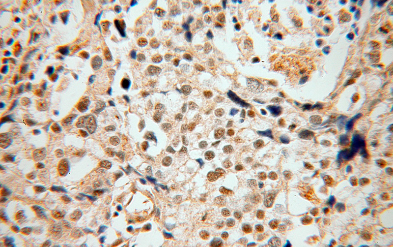 Immunohistochemical of paraffin-embedded human ovary tumor using Catalog No:110002(DMC1 antibody) at dilution of 1:100 (under 40x lens)