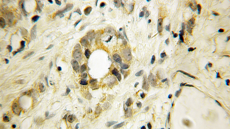 Immunohistochemical of paraffin-embedded human prostate cancer using Catalog No:110527(FAS antibody) at dilution of 1:100 (under 10x lens)