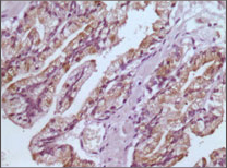 Immunohistochemical analysis of paraffin-embedded human prostate tissues using GSTP1 mouse mAb with DAB staining.