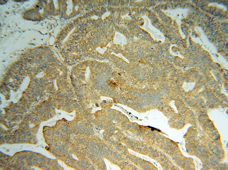 Immunohistochemical of paraffin-embedded human ovary tumor using Catalog No:111199(GRB14 antibody) at dilution of 1:50 (under 10x lens)
