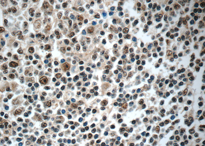 Immunohistochemistry of paraffin-embedded human tonsillitis tissue slide using Catalog No:113018(NLRP1 Antibody) at dilution of 1:50 (under 40x lens)