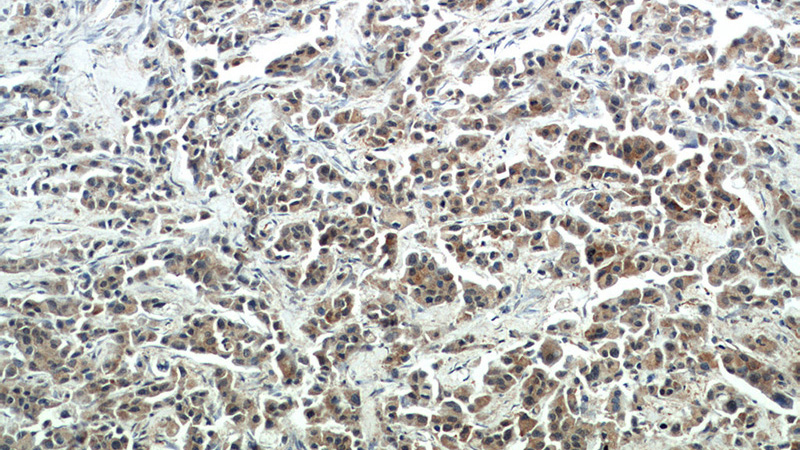 Immunohistochemical of paraffin-embedded human breast cancer using Catalog No:114692(RERG antibody) at dilution of 1:50 (under 10x lens)