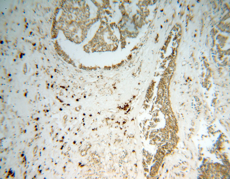Immunohistochemical of paraffin-embedded human breast cancer using Catalog No:111222(HSP90B1 antibody) at dilution of 1:50 (under 10x lens)