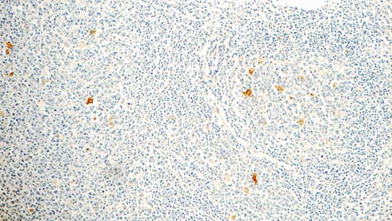 Immunohistochemistry of paraffin-embedded human tonsillitis tissue slide using Catalog No:109384(CLEC4D Antibody) at dilution of 1:50 (under 10x lens)
