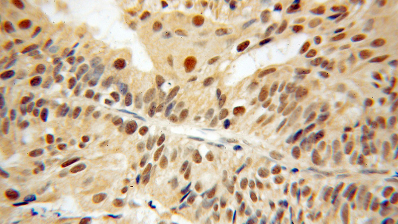 Immunohistochemical of paraffin-embedded human ovary tumor using Catalog No:113484(PAF1 antibody) at dilution of 1:100 (under 40x lens)