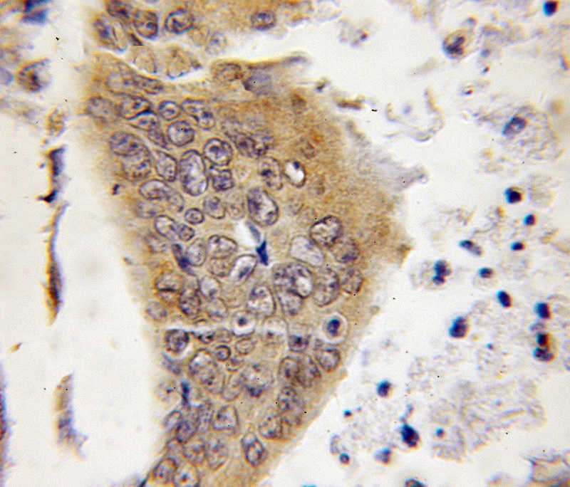 Immunohistochemical of paraffin-embedded human colon cancer using Catalog No:109678(CYLD antibody) at dilution of 1:50 (under 10x lens)