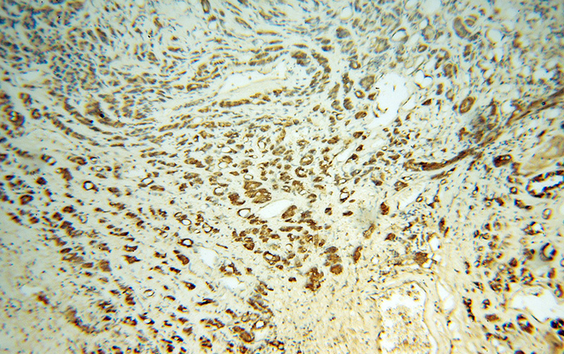 Immunohistochemical of paraffin-embedded human gliomas using Catalog No:107914(AGAP2 antibody) at dilution of 1:100 (under 10x lens)