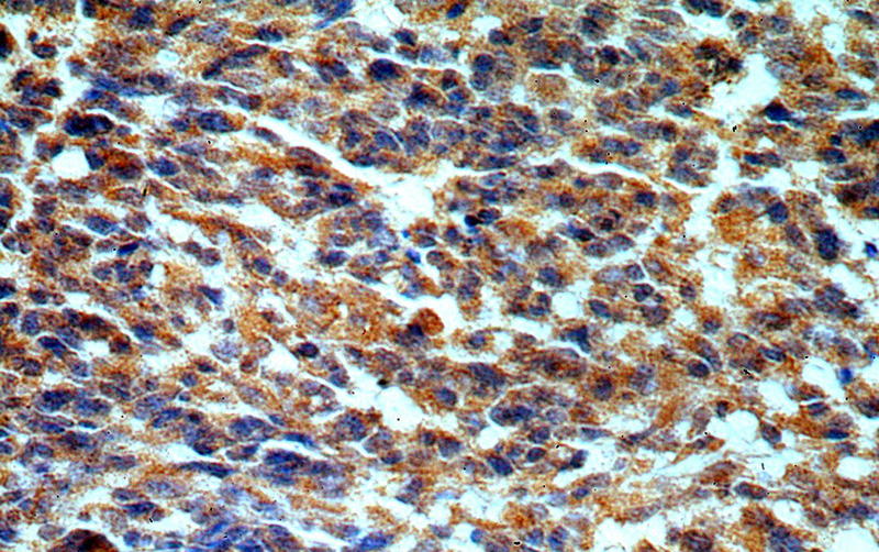 Immunohistochemical of paraffin-embedded human gliomas using Catalog No:115638(STAC3 antibody) at dilution of 1:50 (under 40x lens)