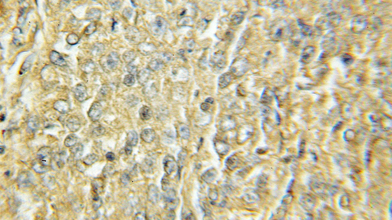 Immunohistochemical of paraffin-embedded human lung cancer using Catalog No:113338(AMY antibody) at dilution of 1:50 (under 10x lens)