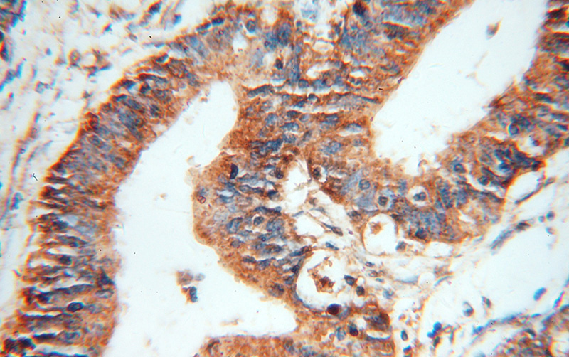 Immunohistochemical of paraffin-embedded human colon cancer using Catalog No:109330(CKMT1A antibody) at dilution of 1:50 (under 40x lens)