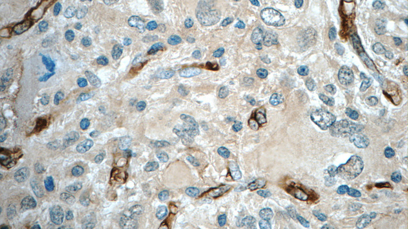 Immunohistochemistry of paraffin-embedded human gliomas tissue slide using Catalog No:110869(GAS1 Antibody) at dilution of 1:50 (under 40x lens)