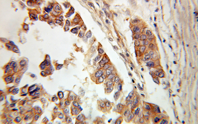 Immunohistochemical of paraffin-embedded human ovary tumor using Catalog No:107867(ADD1 antibody) at dilution of 1:100 (under 10x lens)