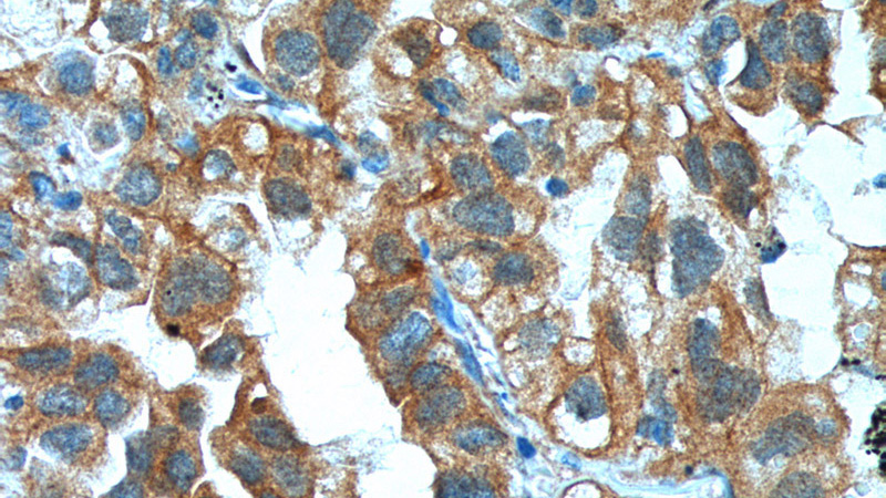 Immunohistochemistry of paraffin-embedded human lung cancer tissue slide using Catalog No:114959(S100A16 Antibody) at dilution of 1:200 (under 40x lens).