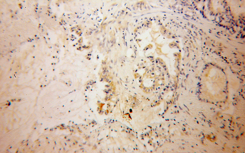 Immunohistochemical of paraffin-embedded human pancreas cancer using Catalog No:111930(KCNF1 antibody) at dilution of 1:100 (under 10x lens)