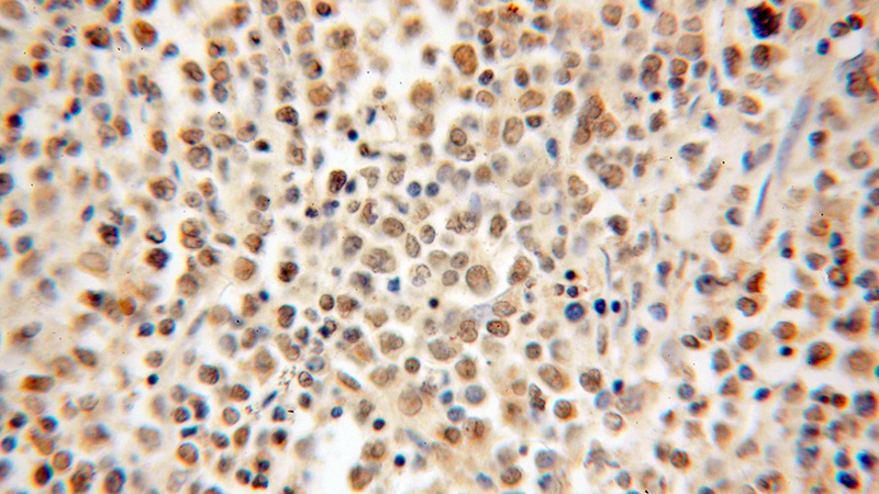 Immunohistochemical of paraffin-embedded human lymphoma using Catalog No:111480(HMGB2 antibody) at dilution of 1:50 (under 40x lens)